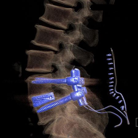 Spinal Implants