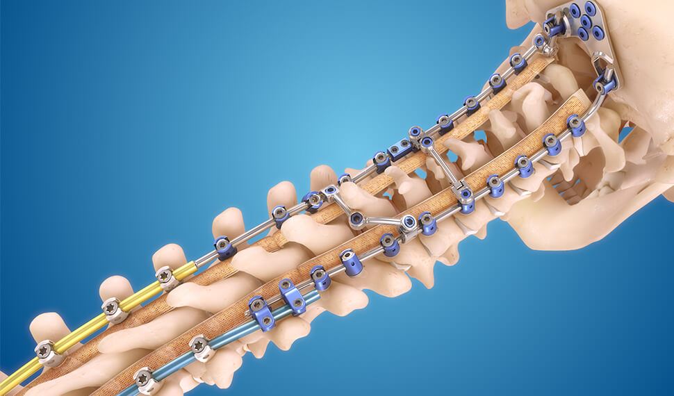 Stainless Steel Spinal Implants